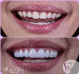 VIV - CONSULTORIO ODONTOLOGICO EN CUCUTA - DISEñO DE SONRISA EN CUCUTA- BICHECTOMIA EN CUCUTA - ORTODONCIA EN CUCUTA
